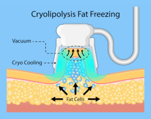 cryolipolysis fat freezing procedure