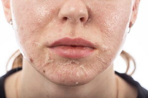 Chemical Peel Side Effects