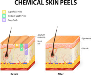 Chemical Peel Types