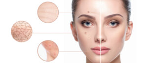 Chemical Peels for Flawless Skin