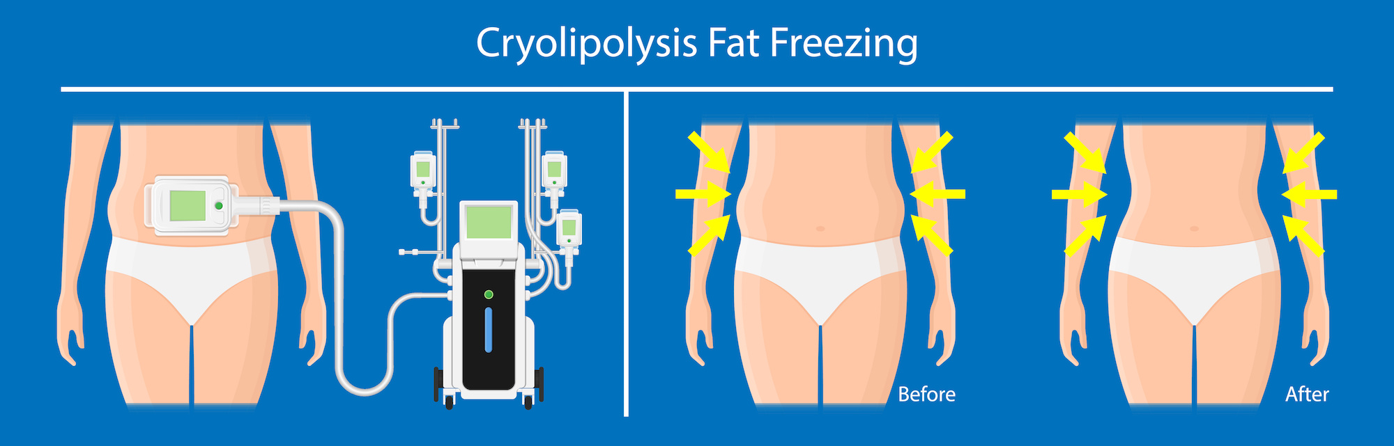 cryolipolysis fat freezing