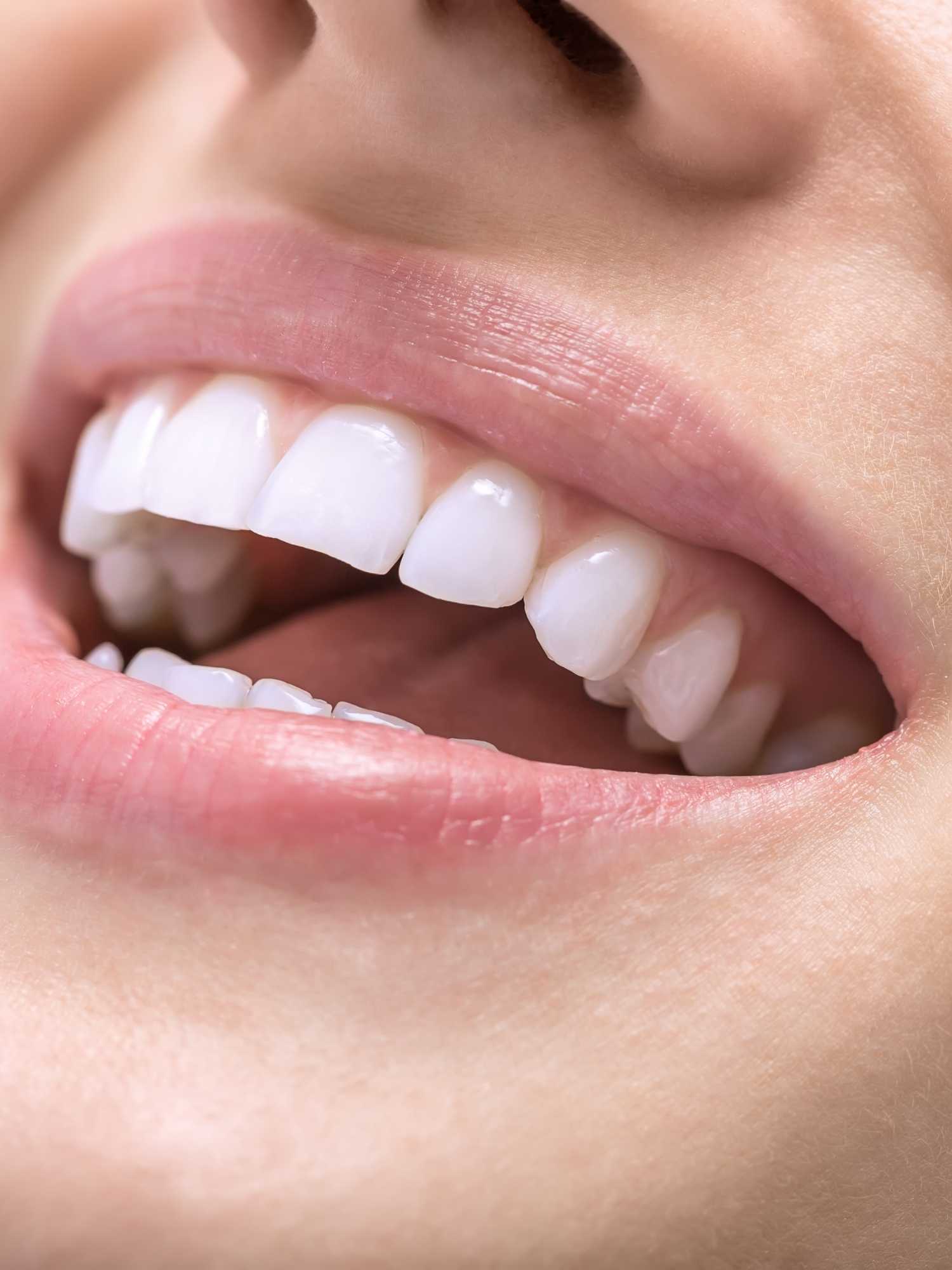 Teeth Whitening NT