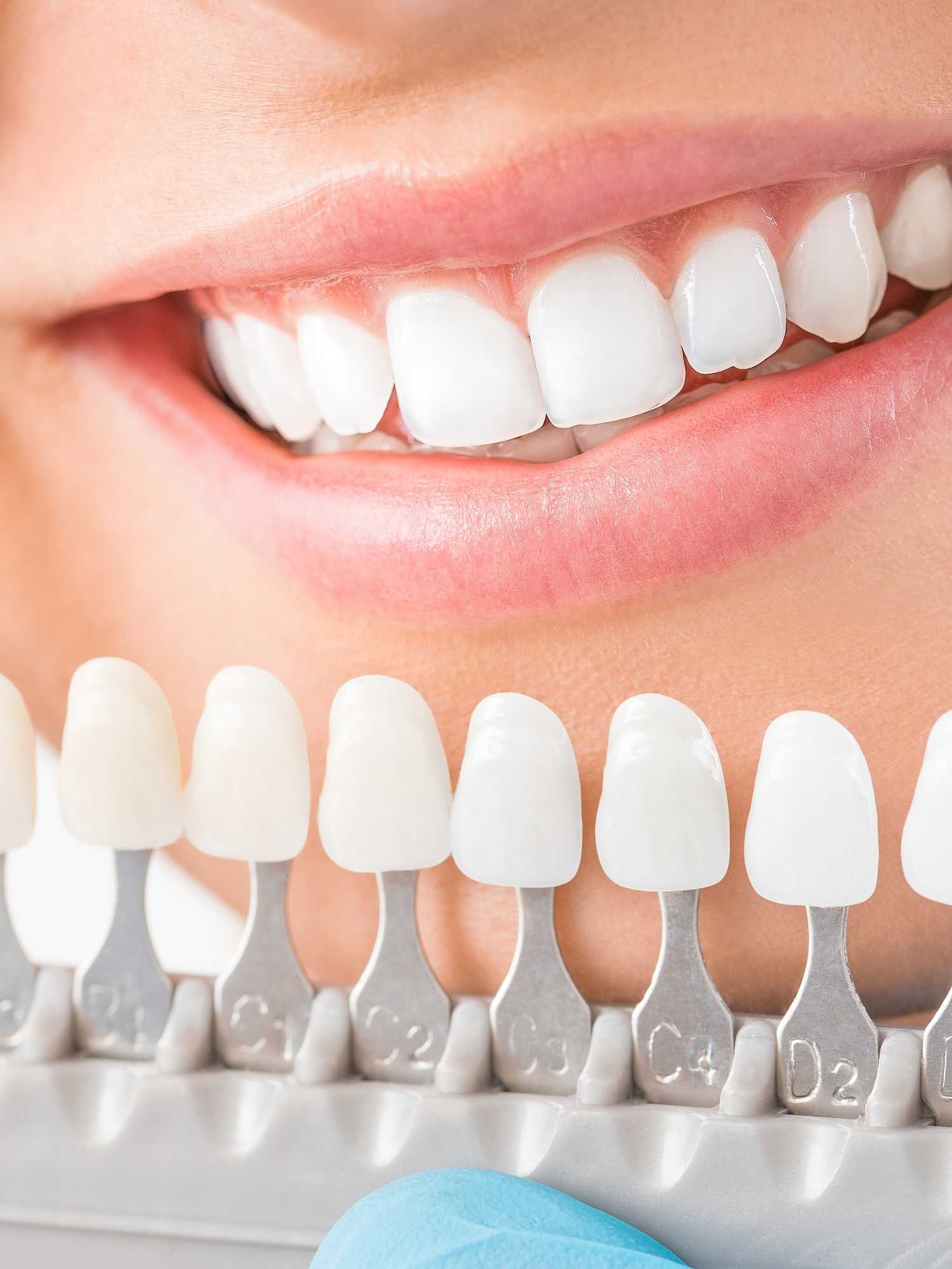 Teeth Whitening QLD