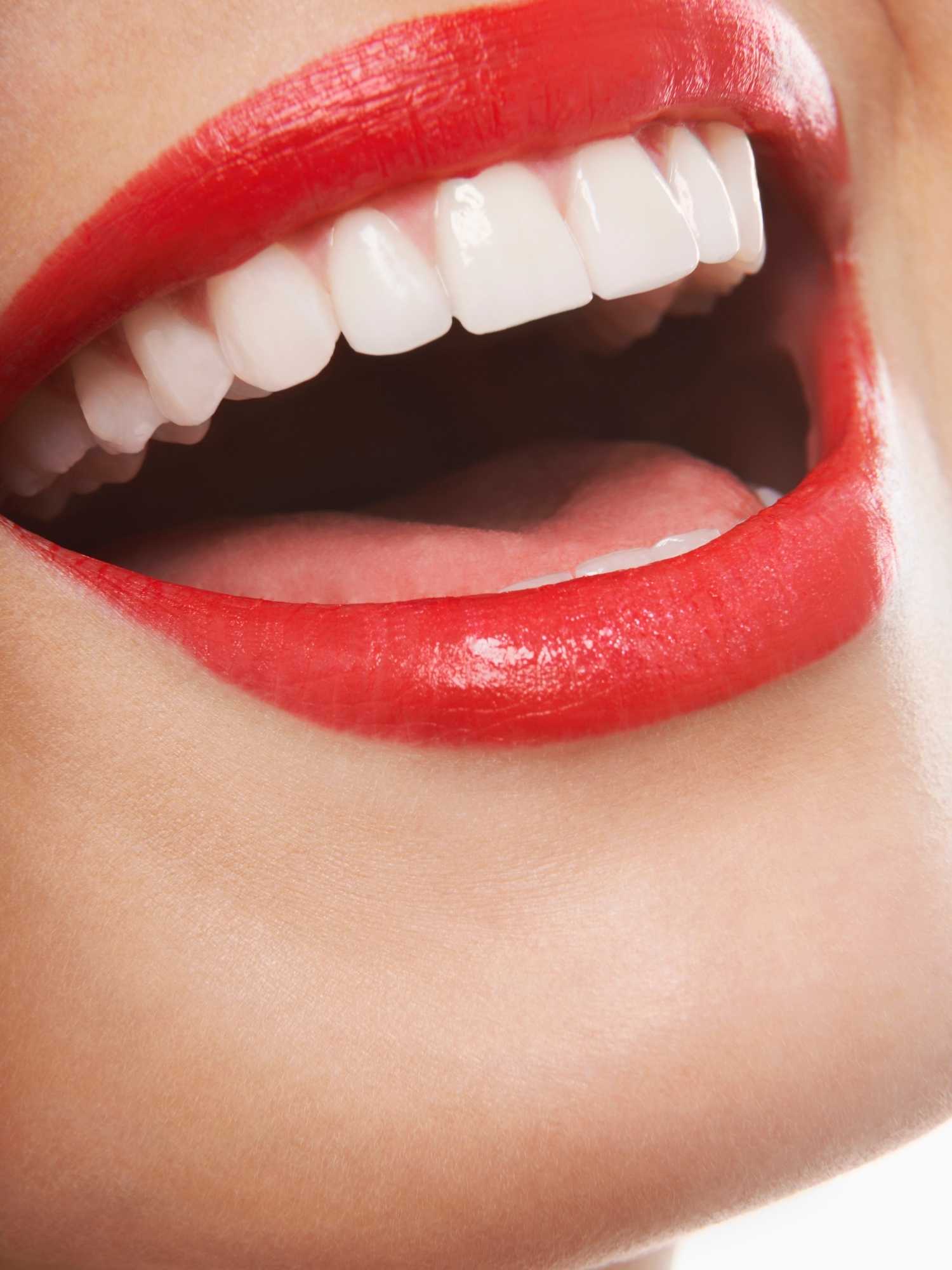 Teeth Whitening WA
