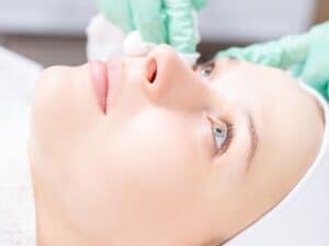 Advantages of Chemical Peel for Hyperpigmentation