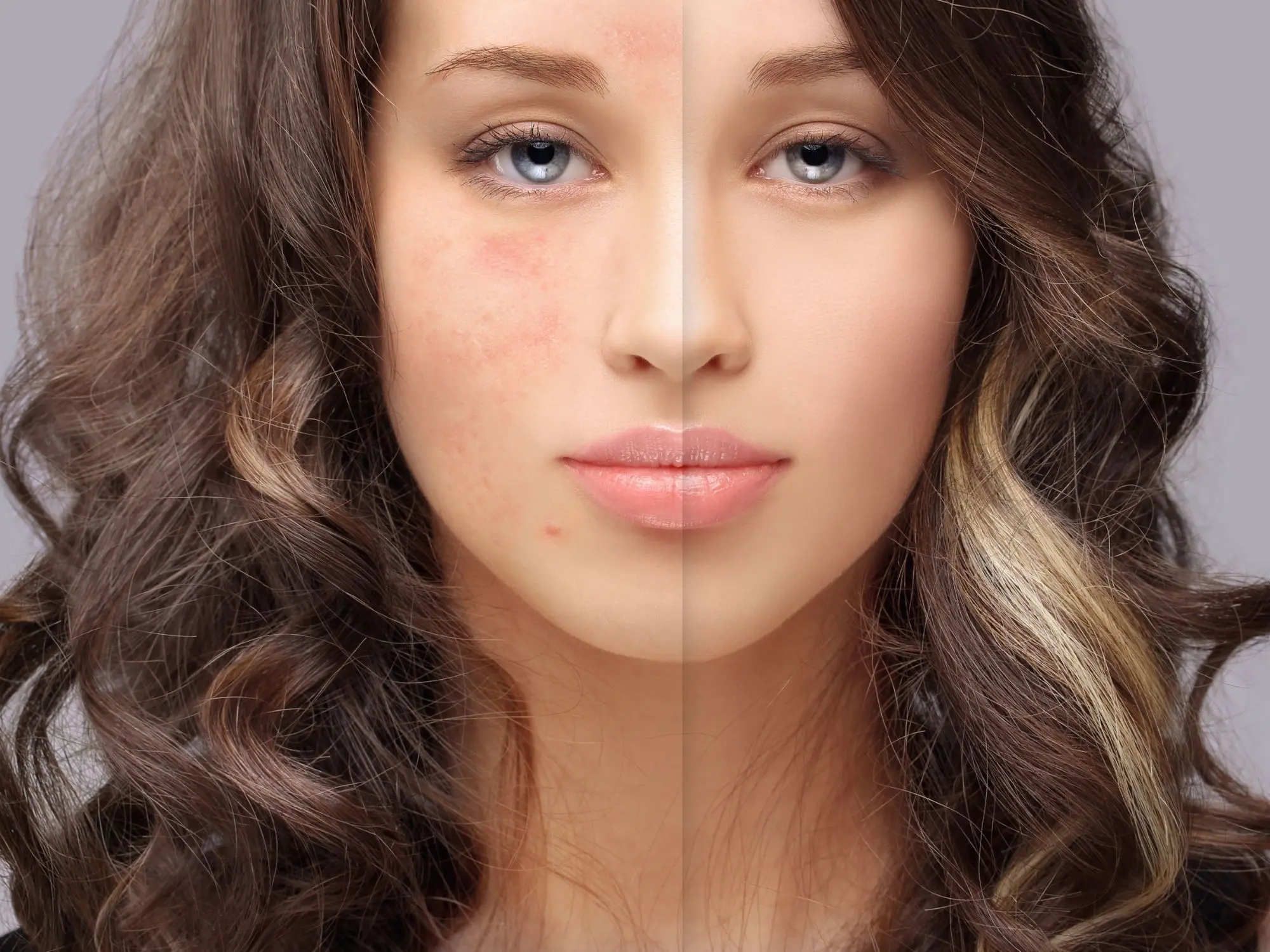 Chemical Peels for Acne Scarring