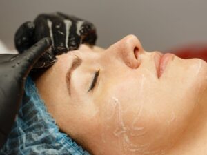 Face Peel for Acne