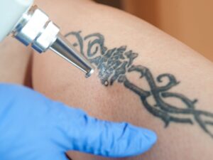 How laser hair removal affects tattoos